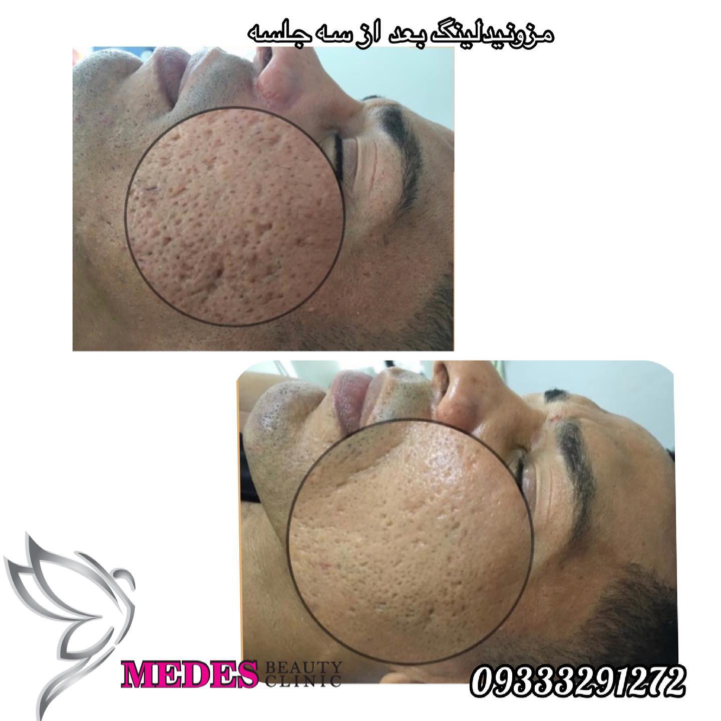 گالری مزونیدلینگ